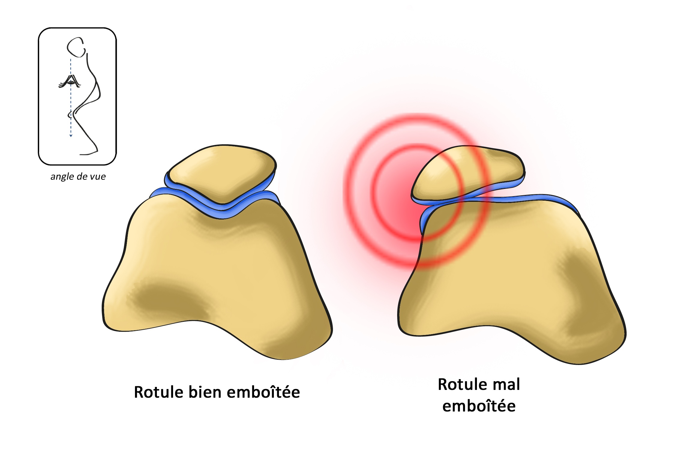 comment renforcer cartilage genou